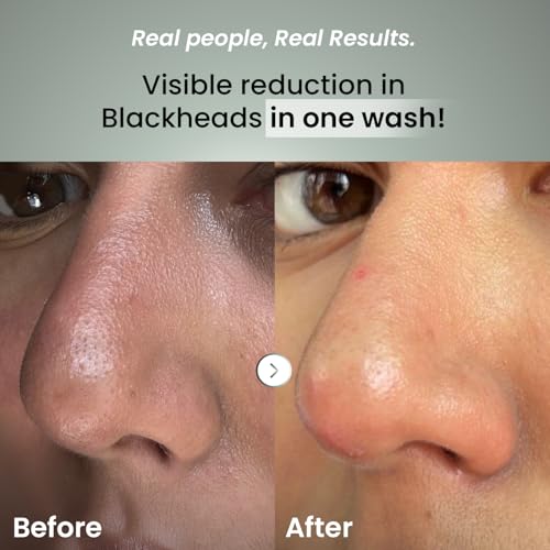 Image of THE SOLVED SKIN Ultra Smooth Daily Facewash with Salicylic & Glycolic Acid | Cleanser for Blackheads, Whiteheads, & Pores | Sensitive, Acne Prone, Bumpy & Oily Skin - 100ml