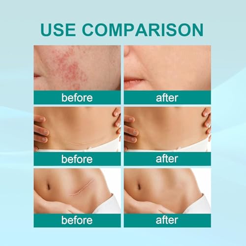 WANMATS Spray curativo per la Cura delle cicatrici, Formula avanzata per Tutti i Tipi di cicatrici, Trattamento per cicatrici da Acne, Spray per cicatrici di Grado Medico