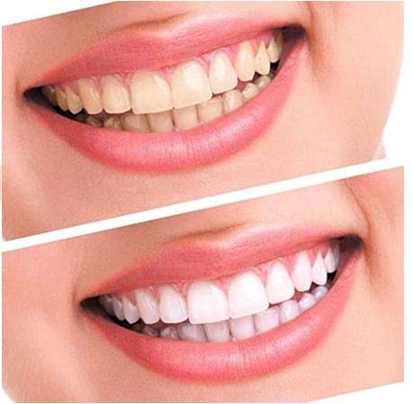 Professional Mint Flavor Advanced Teeth Whitening Strips for Sensitive Teeth 1