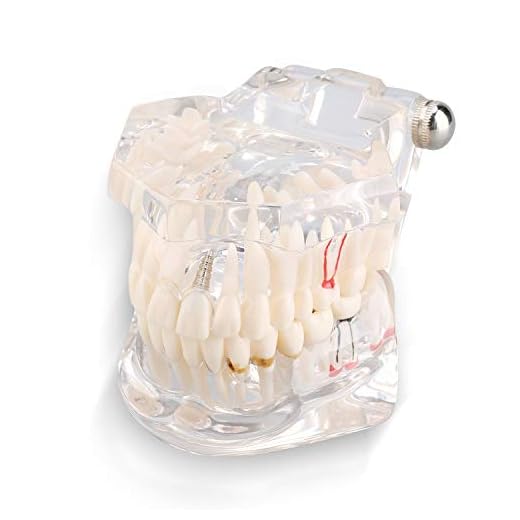 MLMLH Modelo de Dientes Desmontable Adultos, Modelo de Dientes de Implantes Dentales, Enfermedad Transparente Modelo de Dientes, Modelo de Patología de Enseñanza, para Oficinas Dentale