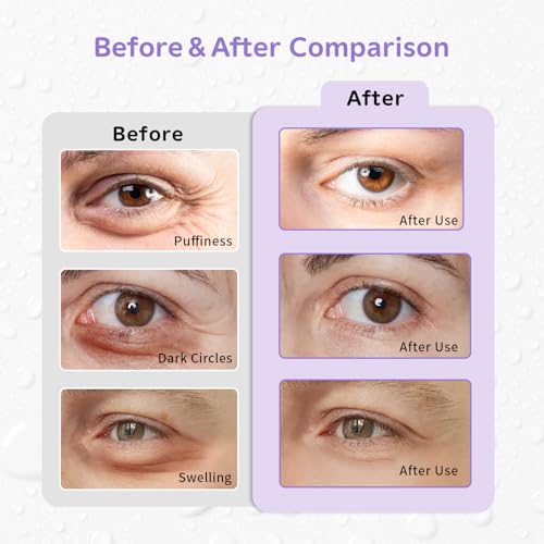Image of 4PCS Gel Eye Ice Pack Set, Cold & Hot Compress, Reusable Cooling Gel Pads for Strain Relief, Swelling, Dark Circles, Redness, Puffy Eyes, Surgery Recovery(4 Purple flowers)