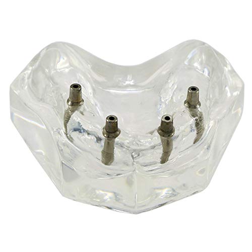 Dentalmall Dental Upper Implants Model Overdenture With 4 Superior Teeth Demo Transparent Vision For Education And Study Model Tool M6001 C #TOP6