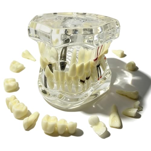 Modèle dentaire transparent : modèle dentaire avec support dentaire, modèle dentaire amovible implant modèle dentaire, modèle dentaire orthodontique, pour la formation et la démonstration