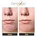 Dermlogic Acne Treatment Pads-Contains Glycolic, Lactic, Salicylic Acid. Eliminates Oily Skin, Clogged Pores & Cystic Breakouts. Removes Dark Spots, Whitehead & Blackhead Pimples for Face & Body.