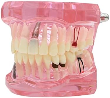 Dentalmall Teeth Model Teeth Typodonts Dental Implant Study Analysis Demonstration Teeth Model #2001 with Restoration Pink