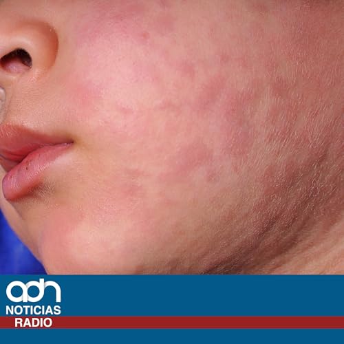 4 alcald&iacute;as de CDMX concentran casos de sarampi&oacute;n