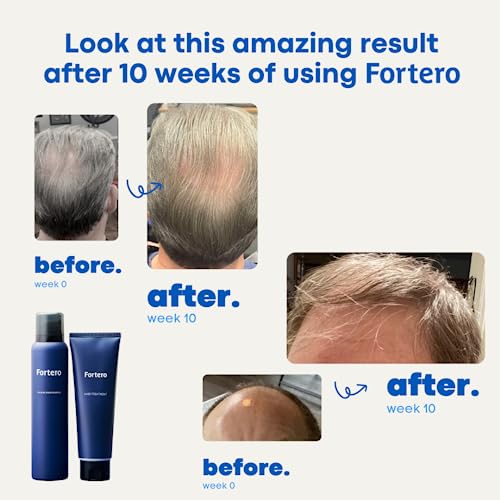 Fortero Carbonic Acid Shampoo, Promotes Healthy, Fuller & Thick Hair Growth For Men, Anti-Thinning Hair Shampoo, All-Natural Ingredients - For All Hair Types (1 Pack) #TOP3