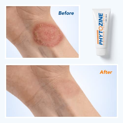 PHYTOZINE Effective Ringworm Treatment For Humans