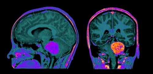 Episode 40 Neuro Protocols with Gadopiclenol