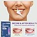 TobleMAX Teeth Whitening Strips – 14-Day Treatment, Non-Slip & Enamel-Safe, 10% Hydrogen Peroxide with Coconut Oil for Sensitive Teeth, Fast Stain Removal