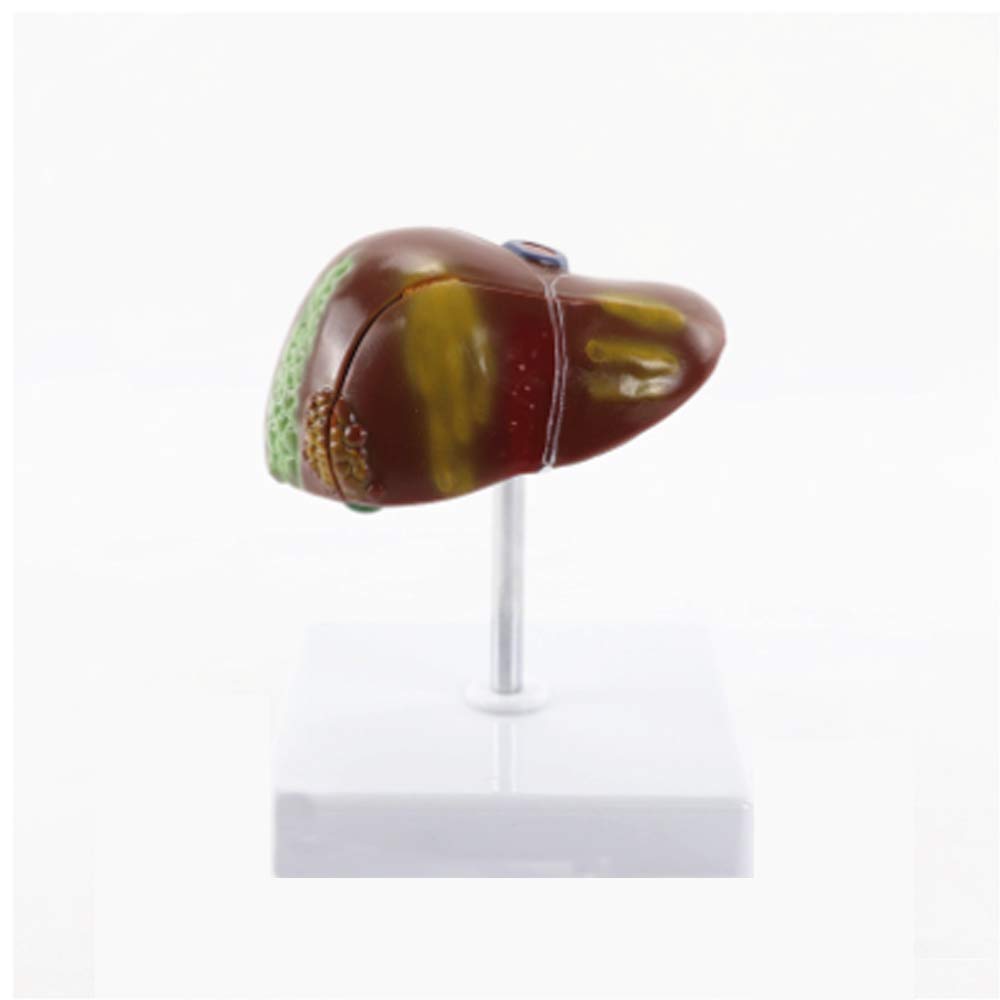 Model Edukacyjny Model Anatomiczny Patologia Wątroby Człowieka Kamień Anatomiczny Model Dla Badań Pedagogicznych Medycznych Materiały Dydaktyczne Laboratorium Demonstracyjne