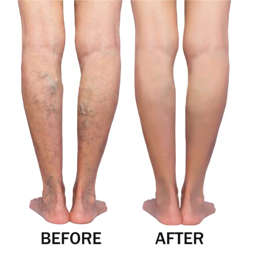 green idea - Rosskastanienmassagegel gegen Krampfadern - Rosskastaniengel und Arnika - Bei Krampfadern und Hämeroiden… - Image 7