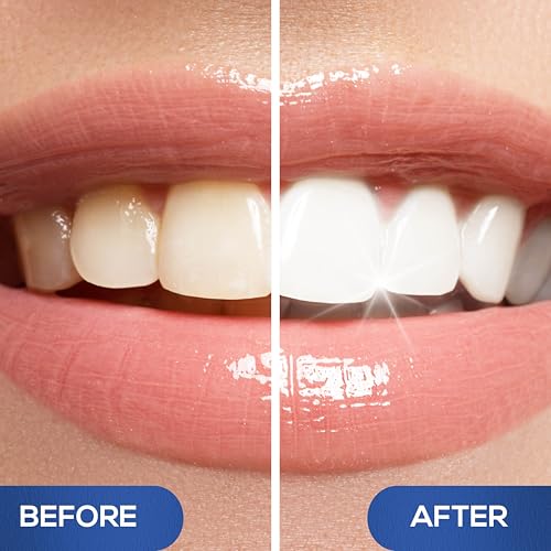 Image of Venus Visage Teeth Whitening Pen (Pack of 4) - Professional Whitening Gel, 30+ Uses, Low Sensitivity, Enamel-Safe Mint Formula - Travel Whitener for Dentures, Coffee, Wine & Tobacco Stains