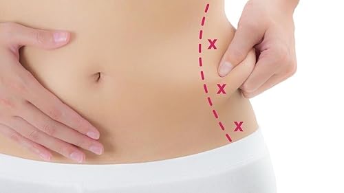 What Are the Long-term Benefits of Liposuction?