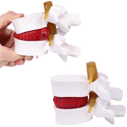 Image of Human Anatomical Lumbar Herniation Model with Nerve Root,Anatomical Vertebrae Model for Education,Excellent Way for Demonstrating Disc(White)