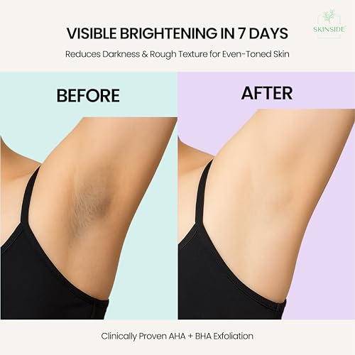 Image of SkinSide 5% AHA-BHA Under Arm Roll On for Dark Underarms | Brightening & Odour Control | Niacinamide + 2.5% Lactic Acid + 2.5% Glycolic Acid | Gentle Exfoliation & Hydration | Alcohol-Free | 50 ml