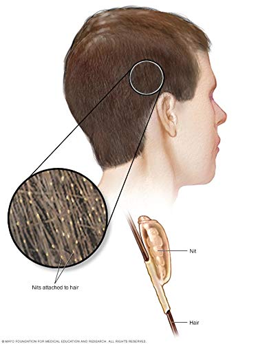 Miniatura 8 de Peine de eliminación de piojos y liendres con doble espiral micro ranurado peine dientes  Un tratamiento de piojos sin químicos  todo tipo de
