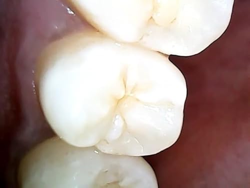 Mouthcam Intraoral Camera thumb #5