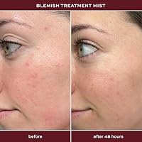 ITK Skincare 2% Salicylic Acid Spray for Face & Body Acne - Blemish-Fighting Treatment for Body Acne, Bacne, Blackheads, Pimples & Blemishes - BHA Blemish Facial Mist Post Workout - 3.3oz Spray Bottle — image 3