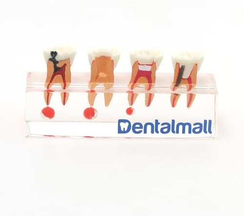 Dental 4-Stage Endodontic Treatment Model for Study Teach Teeth Model 4018 Root Canal Anatomy Demonstration Teaching Tooth Model