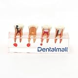 Dentalmall Dental 4-stage Endodontic Treatment Model for Study Teach Teeth Model 4018