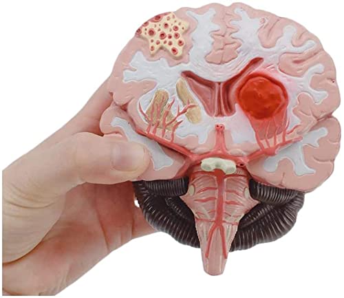 Buy Anatomy Model, Assembly Brain Model Malformed Brain Pathological ...