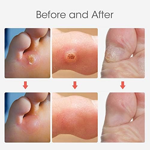 MQUPIN Corn Removal Pads, Wart Remover, Corn Remover Pads, Corn Removal Plaster with Hole, Corn Removal Treatment Relief Corn Pain and Foot Care, Remove Corns, Calluses (24 Count 