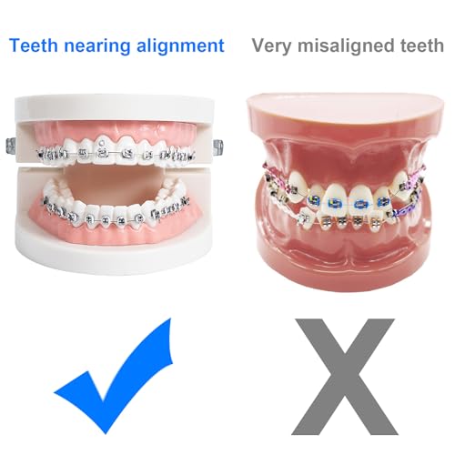 Comfort Cover for Braces, Lip Protector Mouth Guard Lip Cushion Teeth Shield Bumper for Brackets, Aligner, Dental Wax Alternative, Hard and Rigid Clip, in Portable Storage Case with Mirror