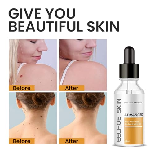 Image of Skin Tag & Mole Remover Serum - Quick-Acting Natural Formula for Face and Body - Simple to Use, 30ML