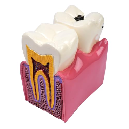 Sarini Zahnmodell, Karies-Vergleichsstudienmodell, Lehrzahnmodell zur Zahnanatomie beim Zahnarzt, geeignet für Zahnärzte, Patienten, Lehrer und Studenten, zahnmedizinische Forschung und Studium