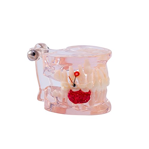 Easyinsmile Dental Teeth Study Teaching Model Clear Mixed Dentition Model with Missing Teeth Pathology Model for Dental Education