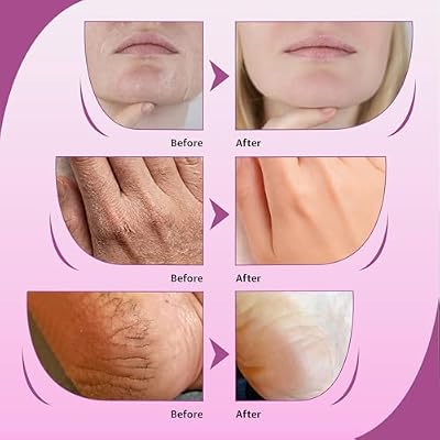 10% Urea Cream with Aloe Vera, Jojoba Oil and Salicylic Acid - 150ml Hydrating Moisturizer for Dry, Chapped Hands, Feet, Face & Body - Repairs, Soothes & Nourishes Rough, Dry Skin - 4 Oz