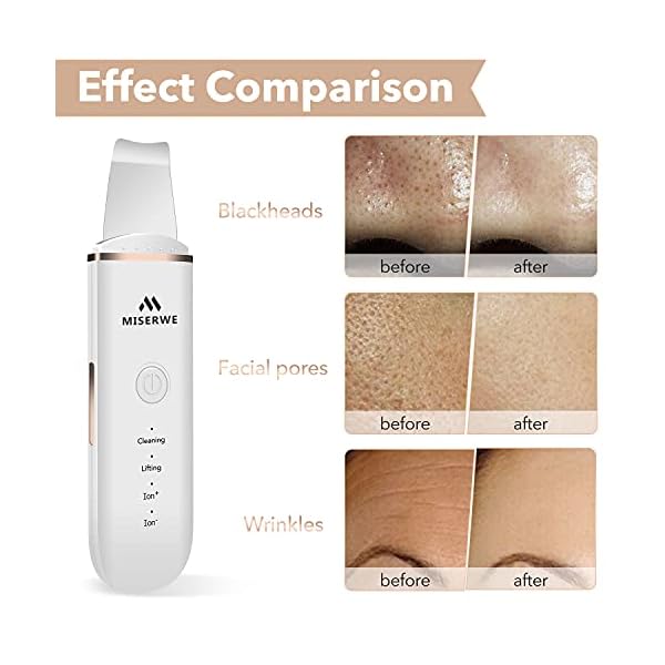 Skin Scrubber Face Skin Spatula Ultraschallpeelinggerät Skin Scrubber Mitesserentferner Porenreiniger Gesicht… – Bild 6