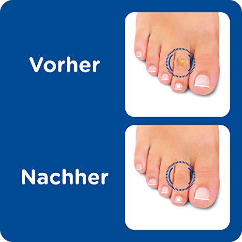 Anti Hühneraugen Stift (4ml) · Burgit · Entfernt Hühneraugen · Schnell · Effektiv · Hühneraugentinktur