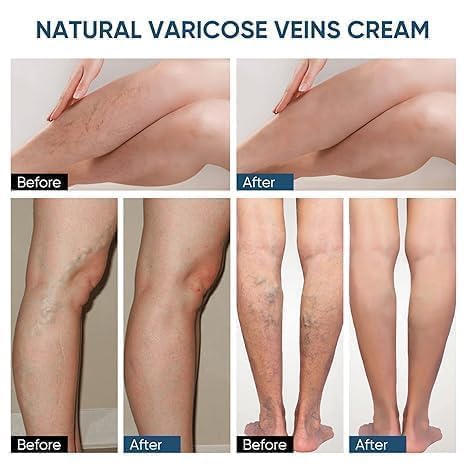Image of Varicose Veins Relief Patches - 12 PICE | Reduces Swelling, Relieves Pain, Improves Blood Circulation & Vein Health | Herbal, Skin-Friendly & Instant Pain Relief (pack of 2)
