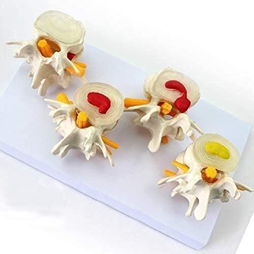 Anatomy Model, Anatomical Model Torso, Human Spine Spine Pathology Demonstration Model, Human Lumbar Lesion Spine Statue Display Model Medical Teaching Learning Tool.ï¼ˆ1 Setï¼‰ for Medical Demonstration