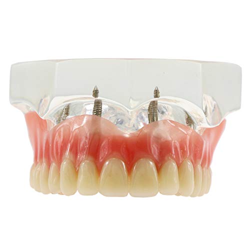 Dentalmall Dental Upper Implants Model Overdenture With 4 Superior Teeth Demo Transparent Vision For Education And Study Model Tool M6001 C #TOP7