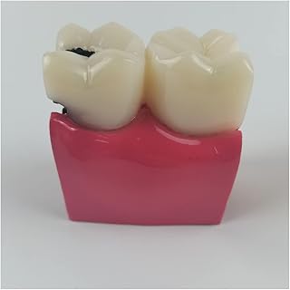 ZMX 6 Times Dental Caries Contrast Model - Teeth Teaching Model - Communication Between Doctors and Patients in The Evolution of Tooth Decay and Caries
