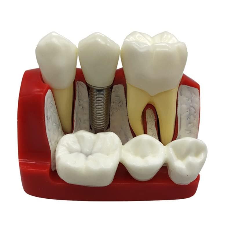 Dental Implant Analysis Model explaining about Implant & Fixed Partial Denture M2017-picture-13