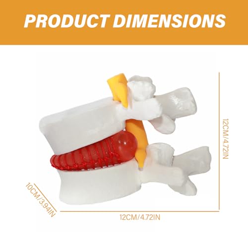 Modèle de hernie discale lombaire pour simplifier les cours d'anatomie complexes