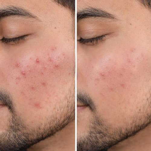 Image of Biomlogy Anti Acne Face Serum 22% Actives with 2% Salicylic Acid, 7% Niacinamide, 2% Ceramide, Prebiotic for Oily & Acne Prone Skin |Controls Excess Oil, Fades Acne Marks, Barrier Care| 10 ML