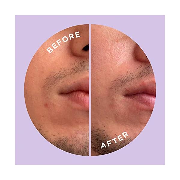 HYPERFADE-by-ZitSticka-Microdart-Patch-to-Fade-Post-Zit-Dark-Spots ZitSticka Hyperfade Acne Patches for Face - World's Most Potent Pimple Patch with Fast-Acting Microdarts - Starts Working within 2 Hours for Deep, Early-Stage Zits & Blemish - 12 Count