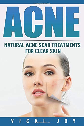 Acne: Natural Acne Scar Treatments for Clear Skin (Clear skin, clear skin diet, acne scar treatment, acne treatment, acne scars, how to get rid of pimples, dermatology)