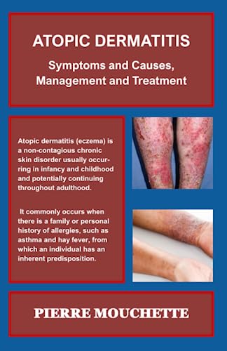 ATOPIC DERMATITIS: Symptoms and Causes, Management and Treatment