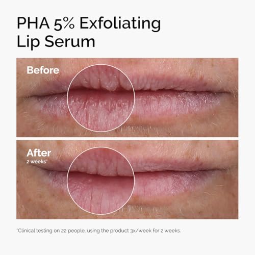 Image of The Ordinary PHA 5% Exfoliating Lip Serum