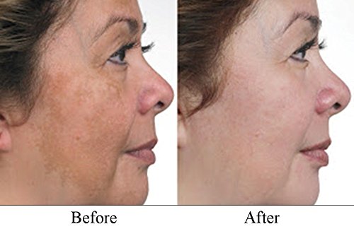 hydroquinone for freckles