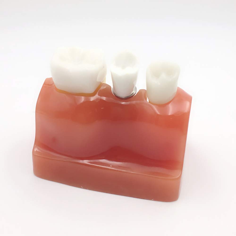 Differenza Tra Corona E Impianto Dentale - Foto 5