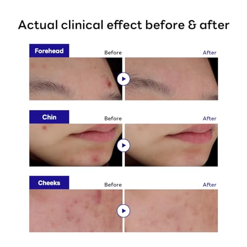 Mediheal Adesivo Derma Clear Madecassoside para manchas (132 unidades) - Proteção contra manchas de