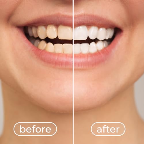 Image of Brightening White Teeth Whitening Foam - 50ml Colour Corrector, Removes Stains, Enamel Safe, Fresh Breath, Easy Home Use for a Radiant Smile