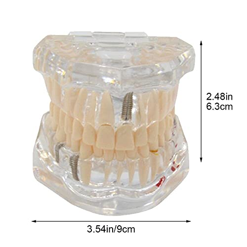 Modèle dentaire de restauration Hrippy pour comprendre l'implant